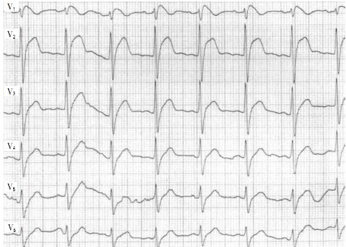 心电图brugada波样改变图片