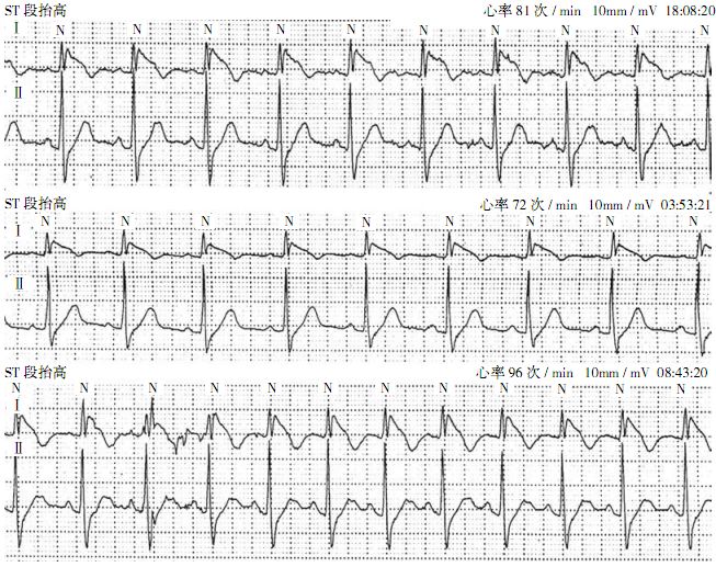 心电图brugada波样改变图片