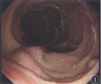 (图1胃镜示十二指肠降段黏膜散在粟粒样白色斑点)