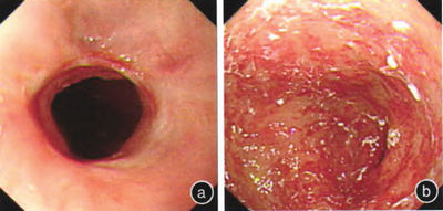 2012年5月24日胃镜检查所见a:吻合口略狭窄 b:残胃弥漫性充血,糜烂)