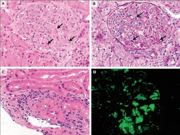 ii型冷球蛋白血癥性腎小球腎炎一例 腎活檢病理結果:①光鏡所見:腎