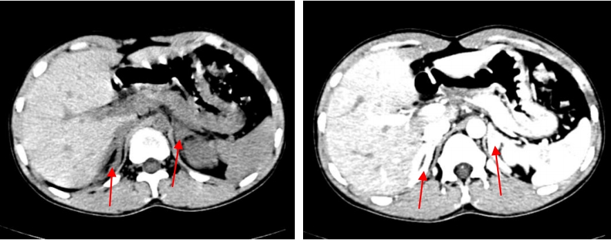 7,肾上腺ct:双侧肾上腺增生             