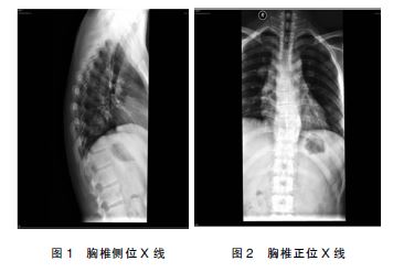 霍奇金淋巴瘤误诊为胸椎结核1例