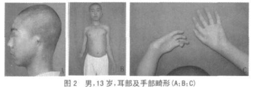 先天性小耳畸形可以单独发生,也可以是综合征的部分表现,常见综合