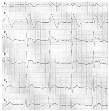 心电图brugada波样改变图片