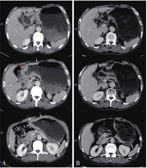 晚期胃窦癌术后肝转移,该如何治疗?