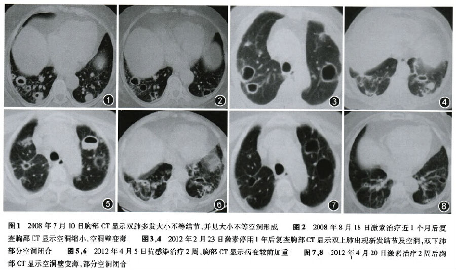 雙肺多髮結節空洞影