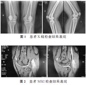 骨梗死早期影像学表现1例