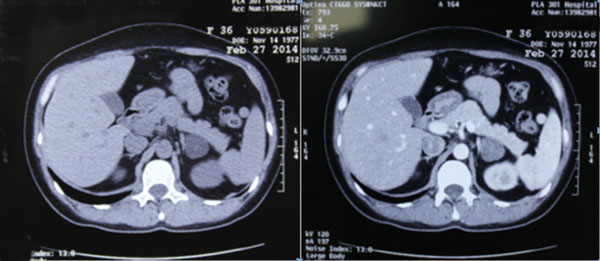 【资料】301医院教学案例:原发性醛固酮增多症