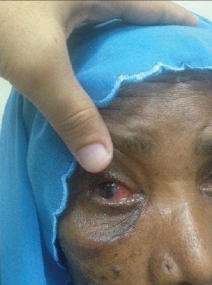 简单的眼球脱位巧妙复位一例