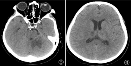 小脑半球ct图片图片