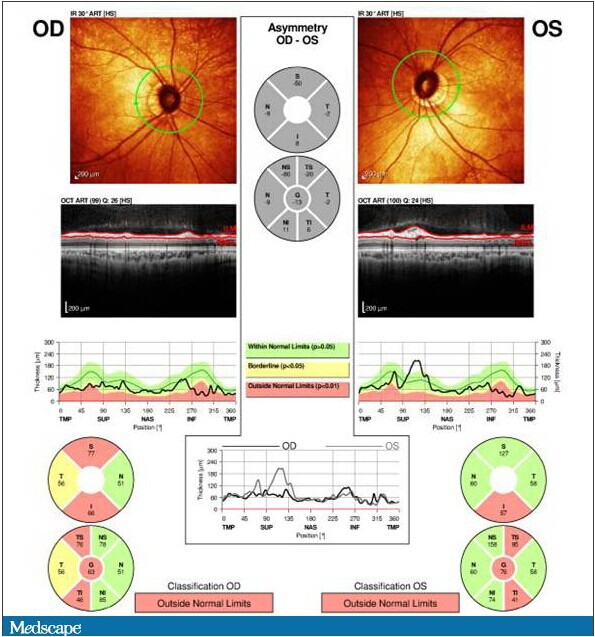 视网膜神经纤维层 oct