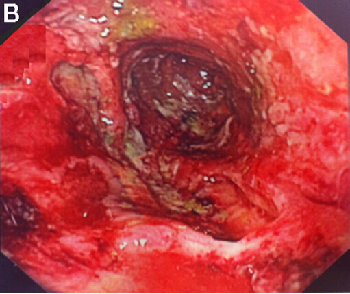 潰瘍性結腸炎症狀_結腸炎的症狀與治療_結腸炎的 . - 直腸炎的症狀