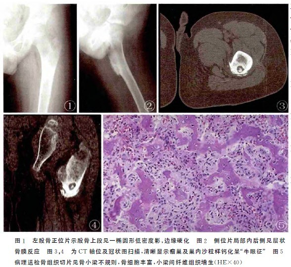 [病例討論] 股骨骨樣骨瘤