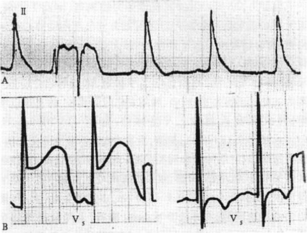 心绞痛发作心电图图片