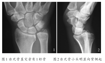 腕关节尺骨茎突旁籽骨