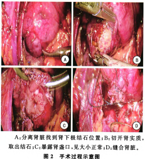 肾窦内肾盂切开取石术图片