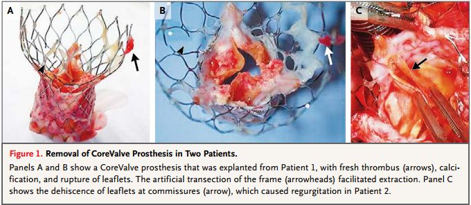 nejm:corevalvetavr术后发生心衰2例分析 - 心血管