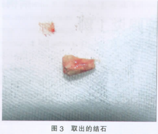 唾液腺导管结石图片