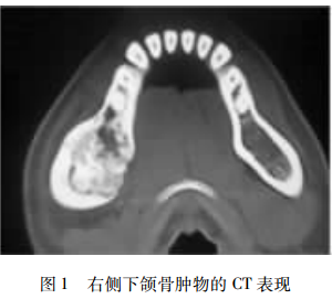 下頜骨骨化性纖維瘤誤診成釉細胞瘤1例