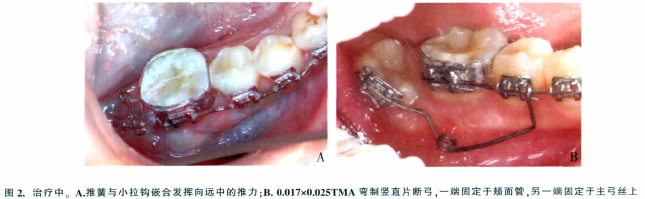 水平低位埋伏下頜第二磨牙的正畸牽引治療:附1例報告