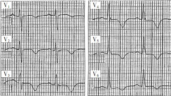 二尖瓣脱垂引起冠状t波改变一例