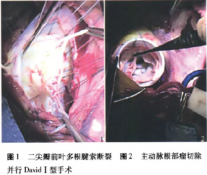 david手术及loop技术治疗马方综合征多瓣膜病变1例
