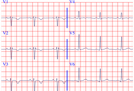 那些暗藏玄機的心電圖(二)