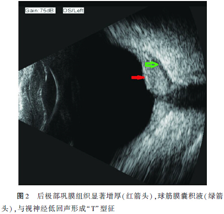 后巩膜炎1例