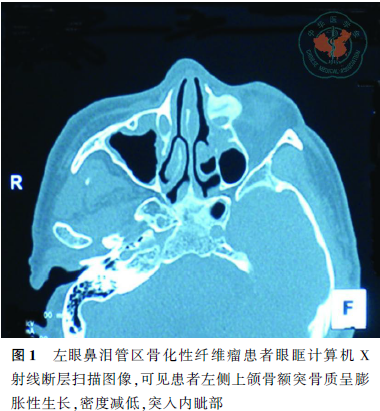 骨性鼻泪管区骨化性纤维瘤