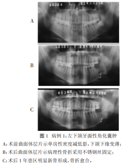 牙源性角化囊腫刮除術後下頜骨病理性骨折2例報告-醫生交流分享-尋醫