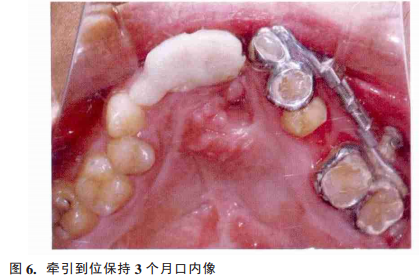 应用牙间牵引成骨辅助唇腭裂牙槽植骨术前治疗1例报告