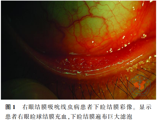 结膜吸允线虫图片