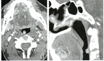咽后壁新生物请诊断