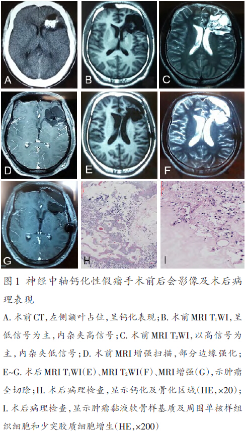 神经中轴钙化性假瘤1例