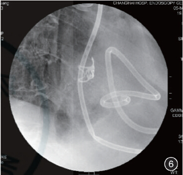鼻空肠管X线图片