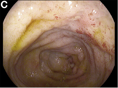 食道,胃,十二指肠镜检查显示食管出现环沟状,疑似为嗜酸性细胞性食管