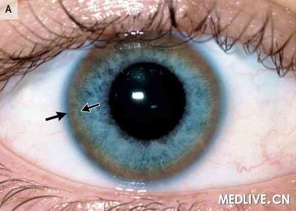 22岁男性,步态混乱,言语迟缓(答案公布)