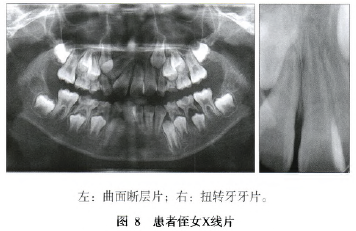 上頜中切牙180°扭轉1例