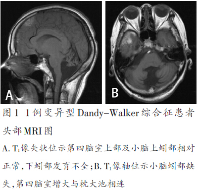变异型dandy-walker综合征3例