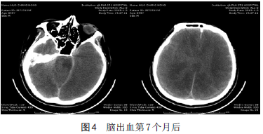 1例脑出血后脑死亡患者头颅ct影像学分析