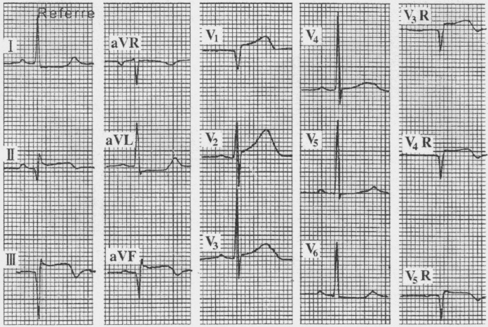 (1)右心功能不全征象:kussmaul征阳性(深吸气时颈静脉怒张,右室舒张末