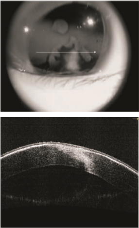 经角膜上皮准分子激光治疗性角膜切削术治疗儿童角膜带状变性一例