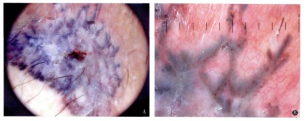 斑呈枫叶样外观,周边可见细小树枝状血管 阴囊色素性基底细胞癌