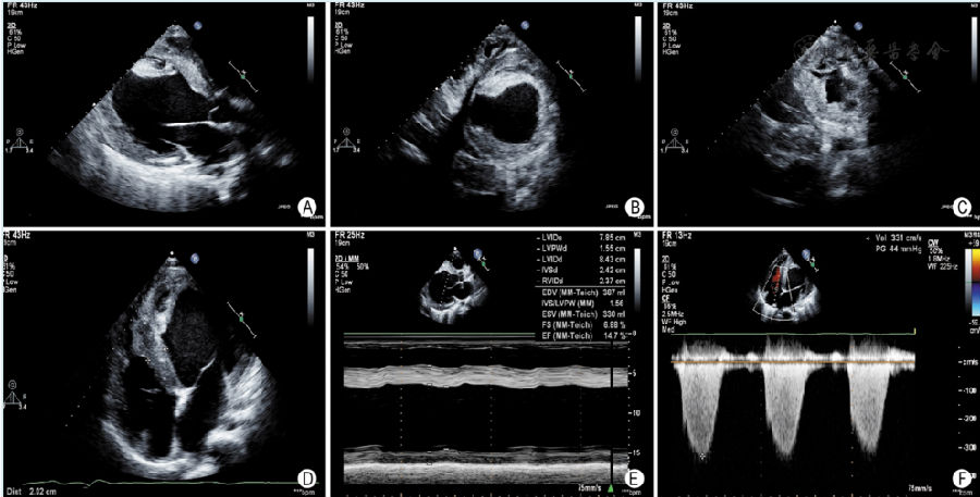 danon病超声表现1例