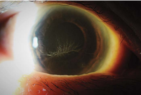50岁,自诉双眼视物时周围有光晕,既往无眼部创伤和角膜屈光手术史