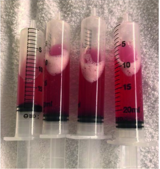 图2 支气管肺泡灌洗液呈血性