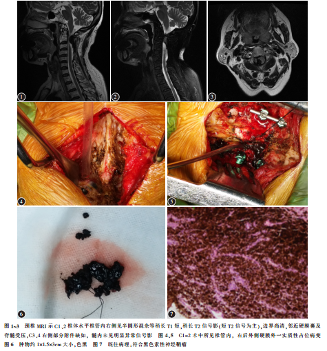 颈椎椎管内髓外黑色素性神经鞘瘤复发1例