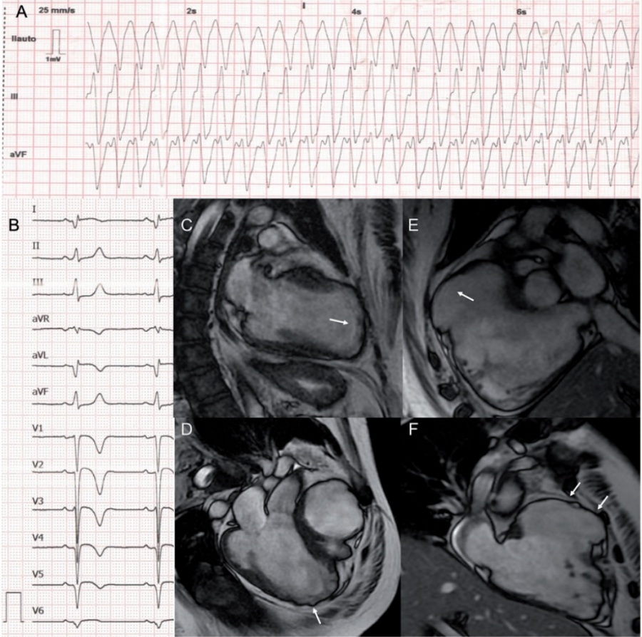 这样的心脏你见过吗可能是一种新的肌病表型