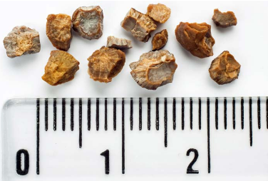 夏季肾结石高发,当心这些症状! | 临床实战